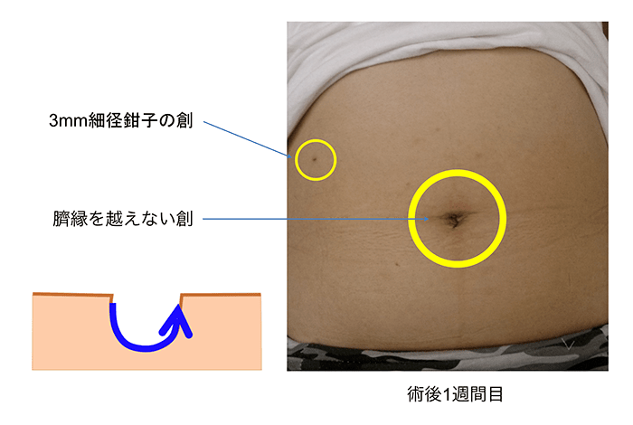 腹腔 鏡 手術 へそ