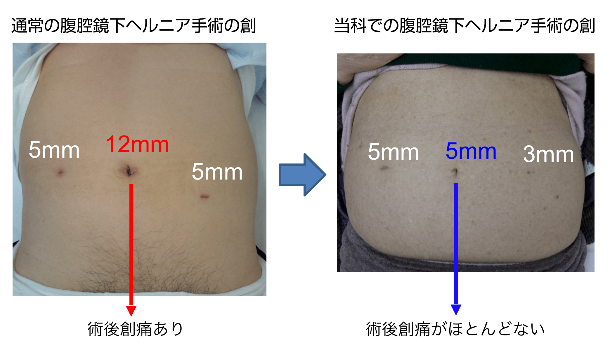 手術 へそ 鏡 腹腔