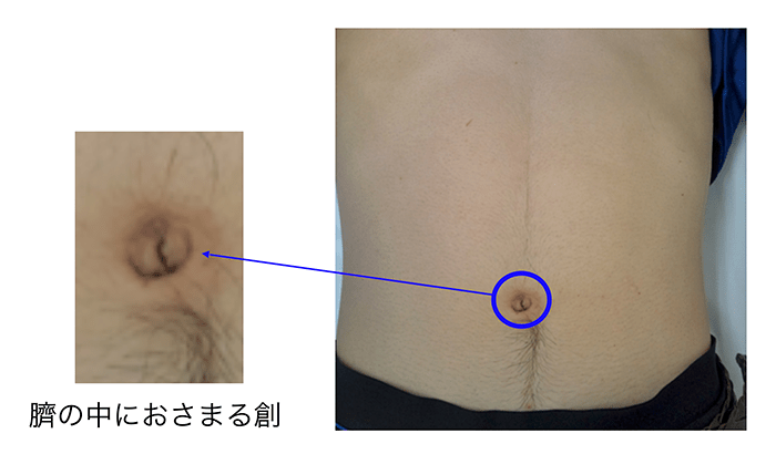 腹腔 鏡 手術 へそ